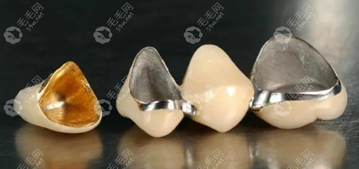 后牙用金属、金属陶瓷材质的牙冠比较经济实惠
