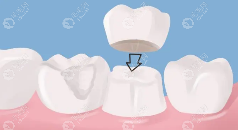 牙冠用什么材质的比较好?材质好的牙冠有：金属牙冠、全瓷牙冠、烤瓷牙冠、金属陶瓷牙冠等