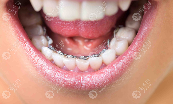 戴舌侧矫正器是不是很不舒服?开始舌头会有点难受,习惯就好