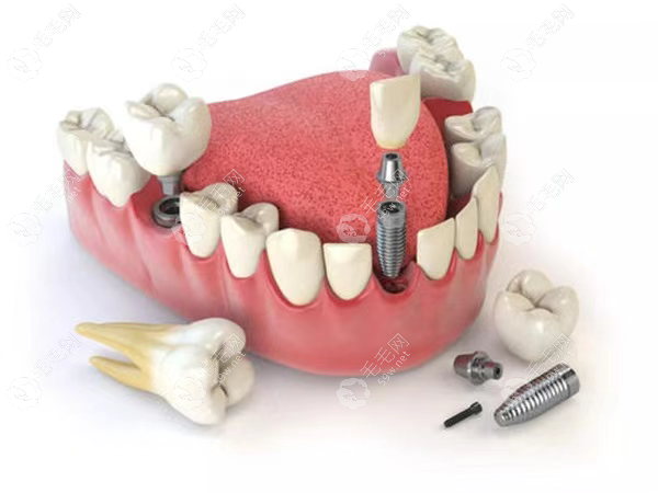 网上种植牙的牙几百块钱是假的,重新种一颗牙要多少钱?