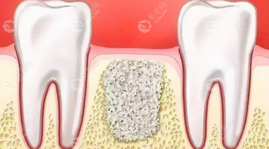 种牙植骨可能用到的材料
