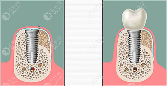 种牙植骨和骨粉的区别:植骨是手段,骨粉是植骨所需材料之一