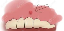 原来牙龈瘘管不能自愈,牙齿瘘管需要做根管治疗手术