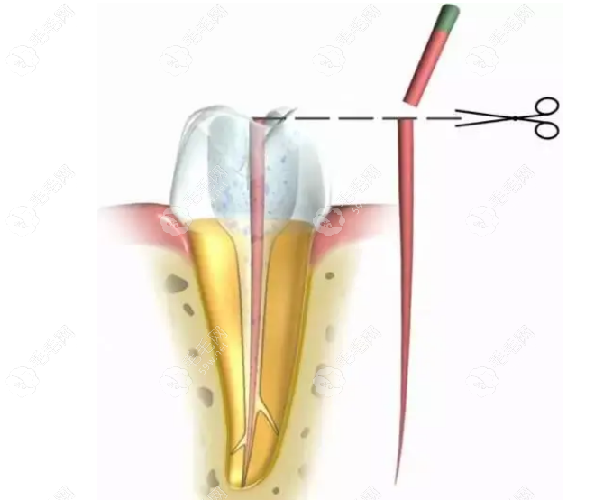 牙神经切断的治疗过程www.59w.net