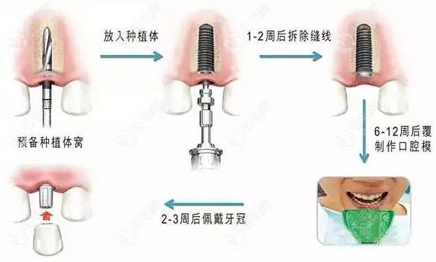 王医生做种植牙手术的原理图