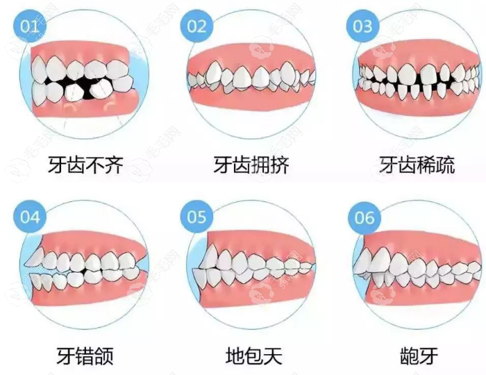 成人牙齿矫正类型