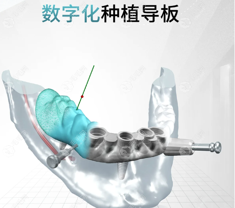 沈阳京科口腔种植牙技术靠谱在数字化种牙更舒适