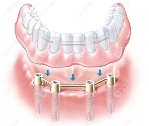 全口all-on-4种植牙技术