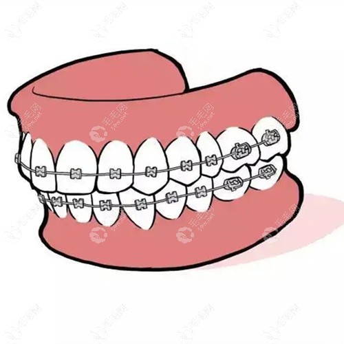 儿童12-14岁左右门牙及牙齿不齐做矫正选金属托槽多