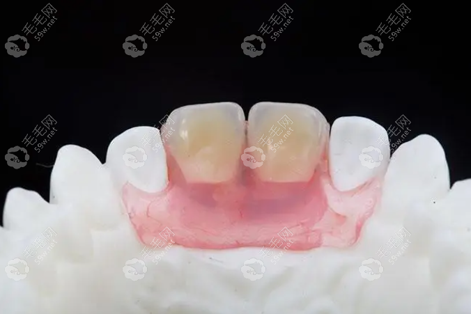 隐形义齿和种植牙哪种好?种牙好,隐形义齿会导致牙龈萎缩哦