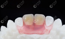 隐形义齿和种植牙哪种好?种牙好,隐形义齿会导致牙龈萎缩哦