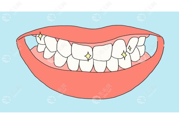 牙齿矫正带牙套要带多久？详解隐形/陶瓷/金属托槽矫正时间