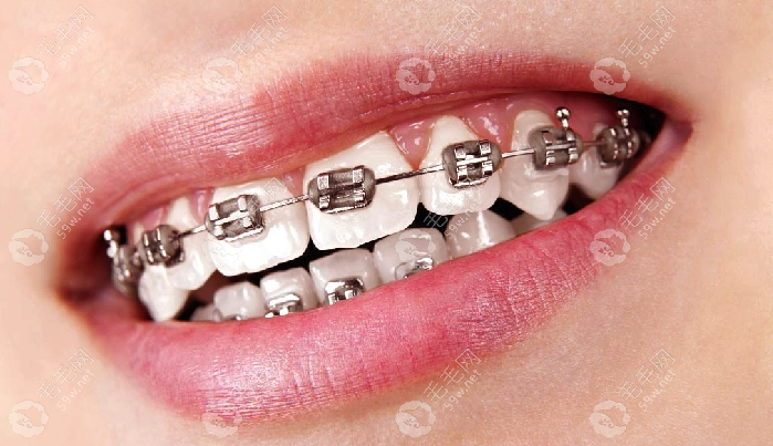 金属托槽牙齿矫正需要佩戴多长时间