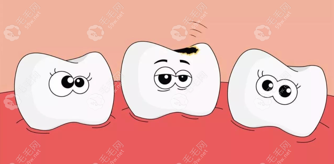 乳牙蛀牙对恒牙的影响
