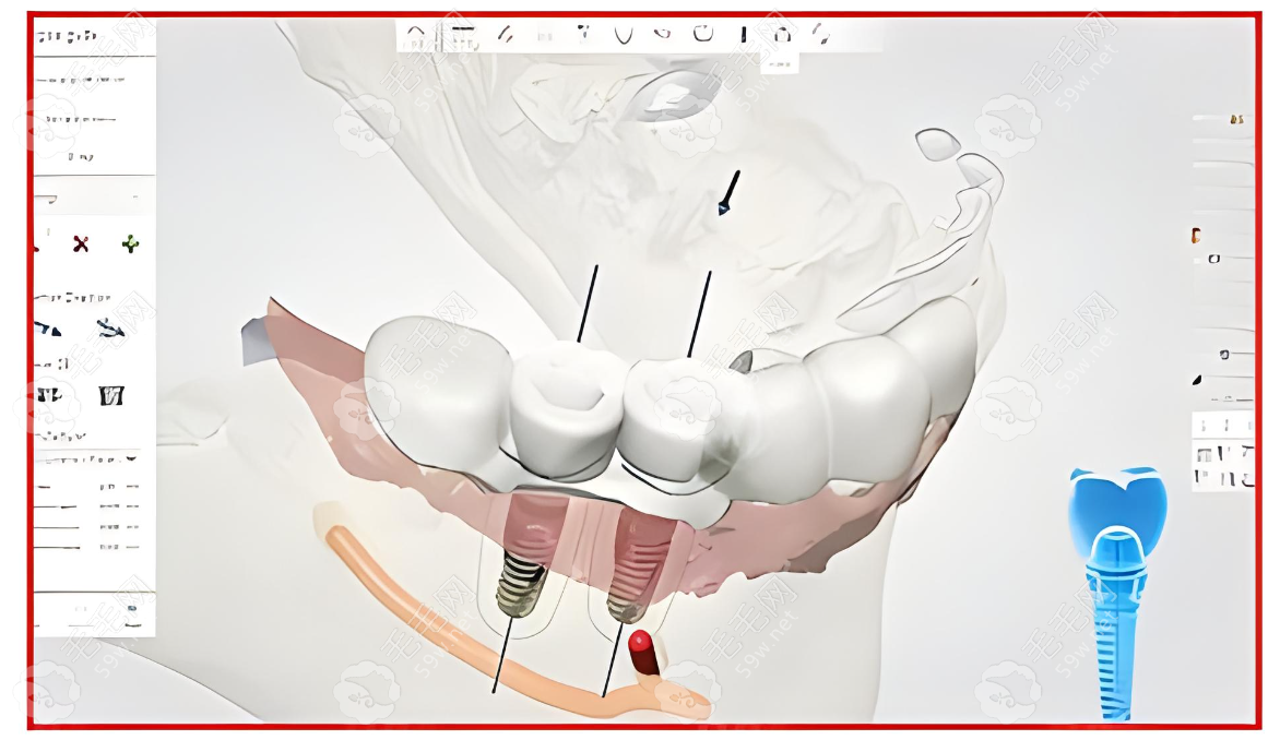 3D导板种植牙技术成熟 m.59w.net