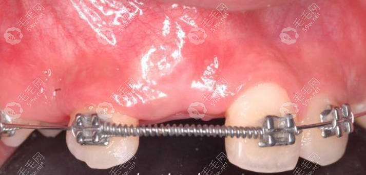 埋伏牙牵引正畸是一种比较常见的牙科治疗方法