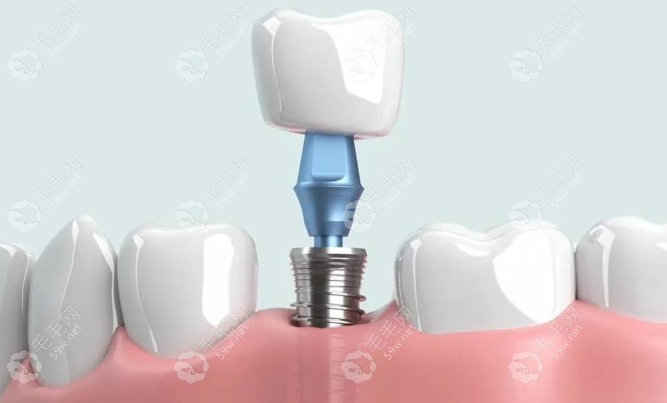 深度解析：每舒达种植牙与登腾种植牙的核心区别所在